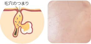 目に見えない毛穴のつまり（マイクロコメド）の症例写真と毛穴の断面図