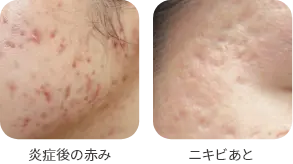 炎症後の赤みの症例写真と毛穴の断面図