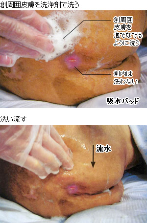図：創周囲皮膚の洗浄方法