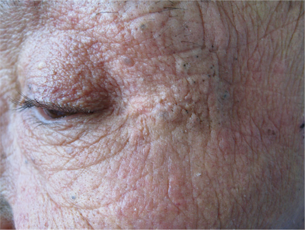 図2. 光老化の皮膚