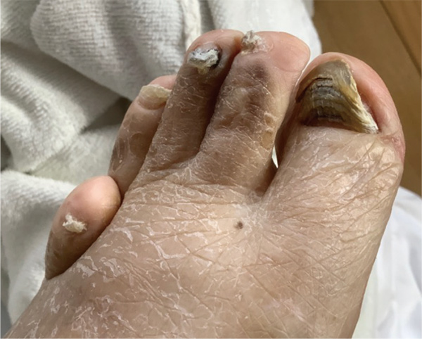 図2. 爪白癬と爪甲鉤彎症