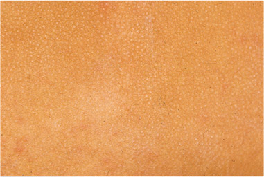 アトピー性皮膚炎患者の乾燥皮膚