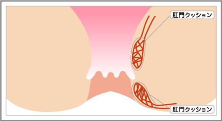 肛門クッション