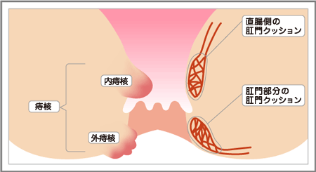 痔核