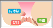 内痔核、裂肛、痔瘻
