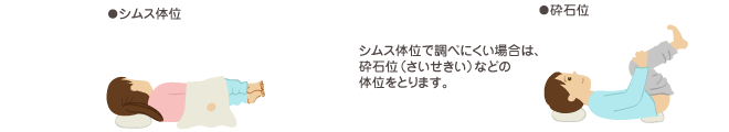 シムス体位と砕石位 シムス体位で調べにくい場合は、砕石位（さいせきい）などの体位をとります。