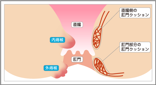 痔核（いぼ痔）