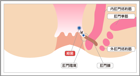 痔瘻ができるまで1