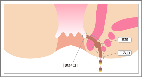 痔瘻ができるまで3 痔瘻