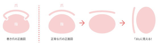 巻き爪画像2.png