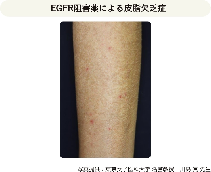 EGFR阻害薬による皮脂欠乏症の写真