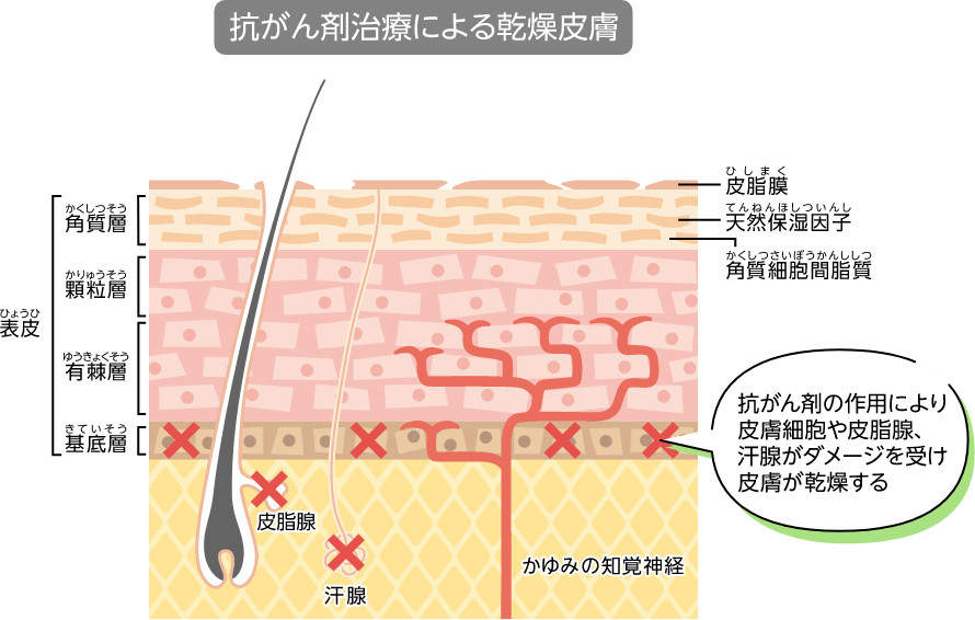 抗がん剤治療による乾燥皮膚