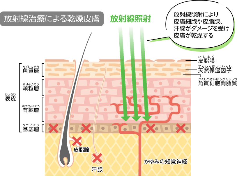 放射線治療による乾燥皮膚