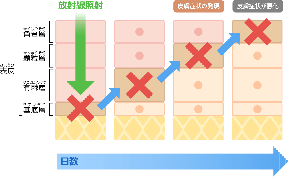 放射線照射による皮膚症状の発現時期