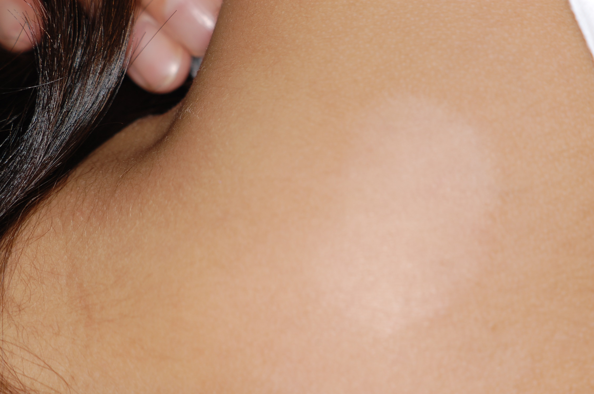 単純性粃糠疹（たんじゅんせいひこうしん）【はたけ】