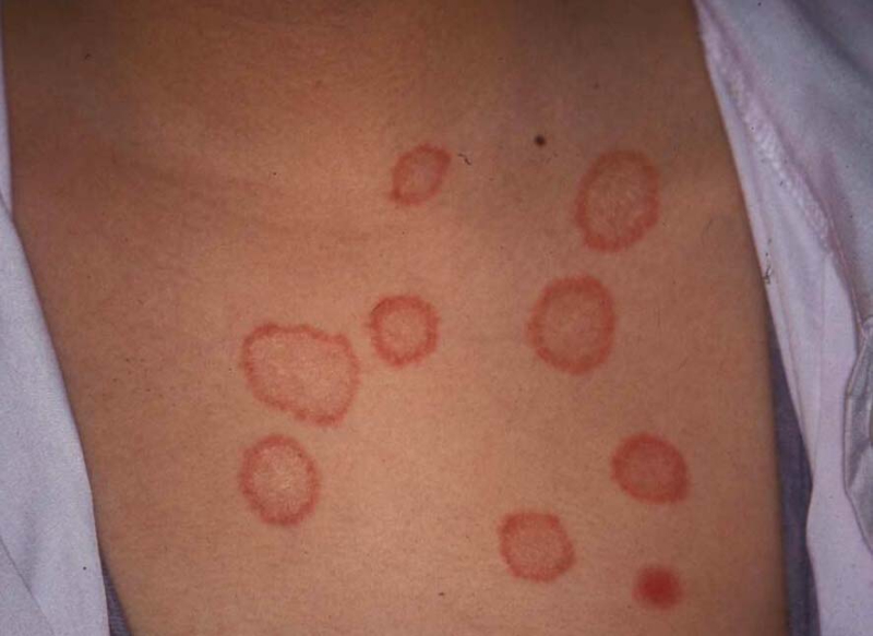 体部白癬（たいぶはくせん）[ぜにたむし]