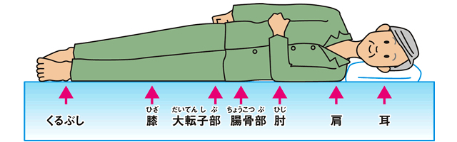褥瘡(じょくそう・床ずれ)ができやすいところ：横向きに寝ている場合 