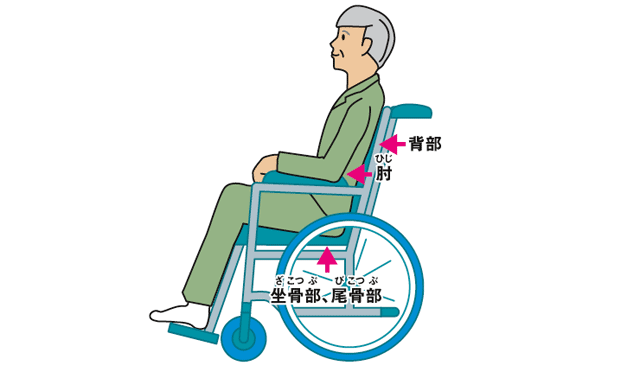 褥瘡(じょくそう・床ずれ)ができやすいところ：車いすに座っている場合 