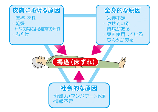 図：褥瘡(じょくそう・床ずれ)の原因