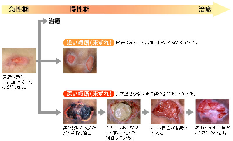 やすい 内出血 人 し