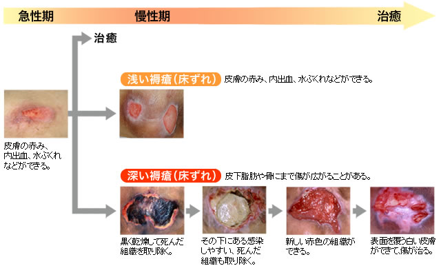 図1：褥瘡(じょくそう・床ずれ)の症状と治癒過程