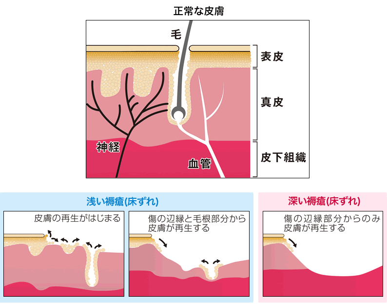 じょくそう 段階 画像