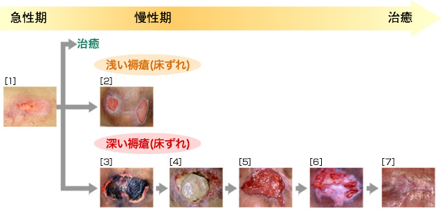 図：褥瘡(じょくそう・床ずれ)の進行と治癒過程 