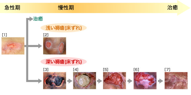 段階 画像 じょくそう 看護ネット｜床ずれ（褥瘡）の予防