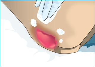 褥瘡(じょくそう・床ずれ)および皮膚の洗浄 