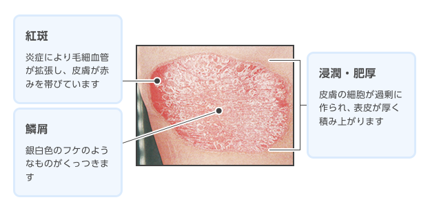乾癬 かんせん って どんな病気 乾癬 Com マルホ株式会社