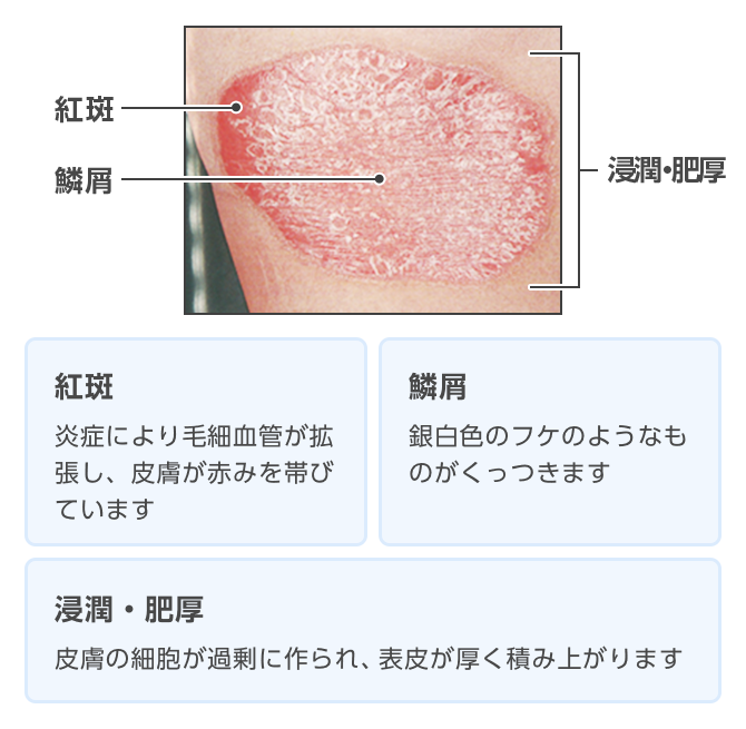 乾癬の症状の一例、紅斑、鱗屑、浸潤・肥厚
