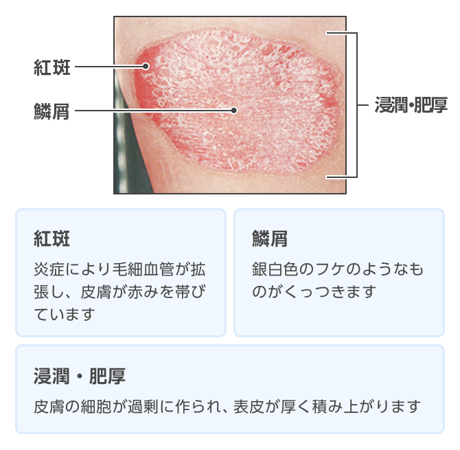 乾癬 かんせん って どんな病気 乾癬 Com マルホ株式会社