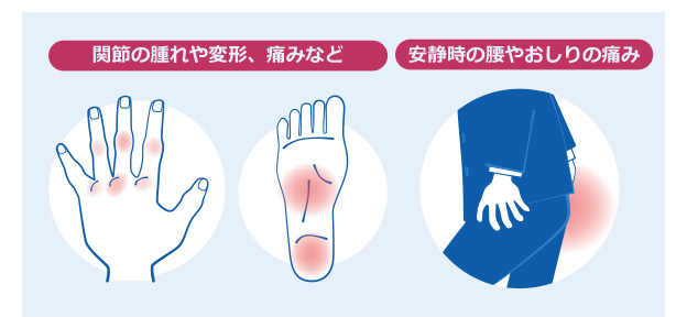 乾癬性関節炎の症状（関節の腫れや変形、痛みなど。安静時の腰やおしりの痛み）