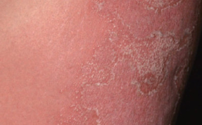 重症度別の症状