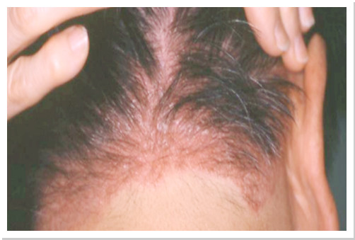 逆性乾癬に関するよくある質問