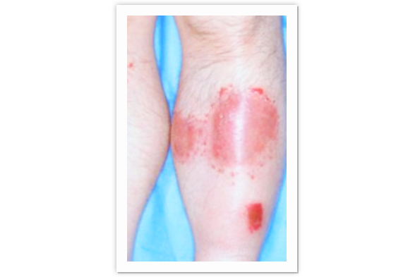 トラタミエント