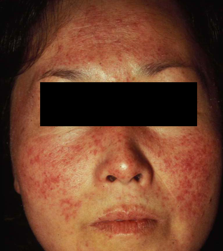 酒さ様皮膚炎（しゅさようひふえん） 