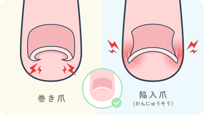 あなたは本当に巻き爪 巻き爪 と 陥入爪 を見分けよう 巻き爪 陥入爪専門メディア 巻き爪を知る 治す 予防する 製薬会社のマルホ