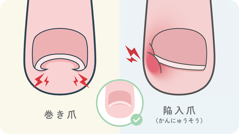 あなたは本当に巻き爪？「巻き爪」と「陥入爪」を見分けよう