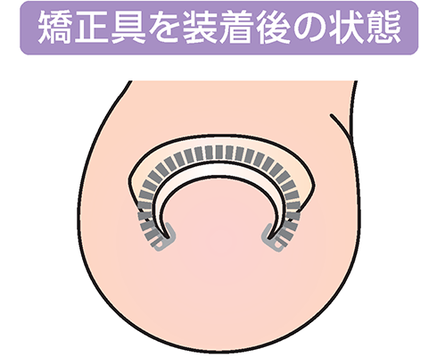 矯正具を装着後の状態