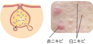 コメド（白ニキビ、黒ニキビ）の症例写真と毛穴の断面図