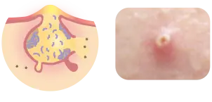 化膿したニキビの症例写真と毛穴の断面図