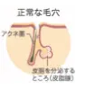 ニキビは毛穴にできる病気です