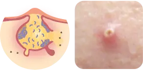 化膿したニキビの症例写真と毛穴の断面図