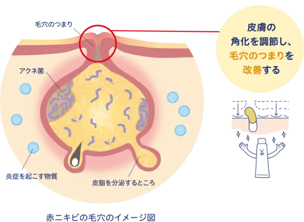 ニキビの原因とディフェリンゲルのはたらき