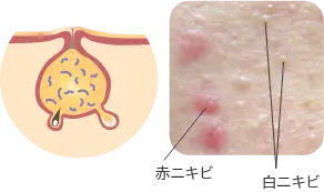 コメド（白ニキビ、黒ニキビ）の症例写真と毛穴の断面図