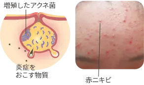 赤ニキビの症例写真と毛穴の断面図