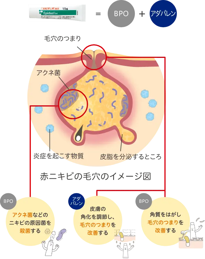 ニキビの原因とエピデュオゲルのはたらき