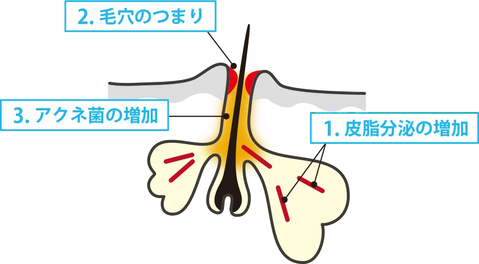 1.皮脂の分泌の増加 2.毛穴のつまり 3.アクネ菌の増加