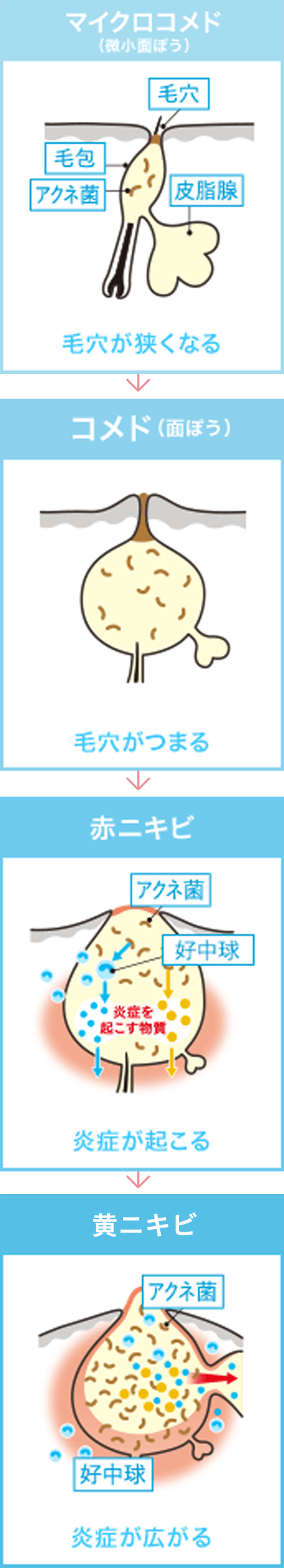 あごニキビの原因と治し方は ニキビを治したい 教えてアキ先生 ニキビ一緒に治そうproject 製薬会社のマルホ